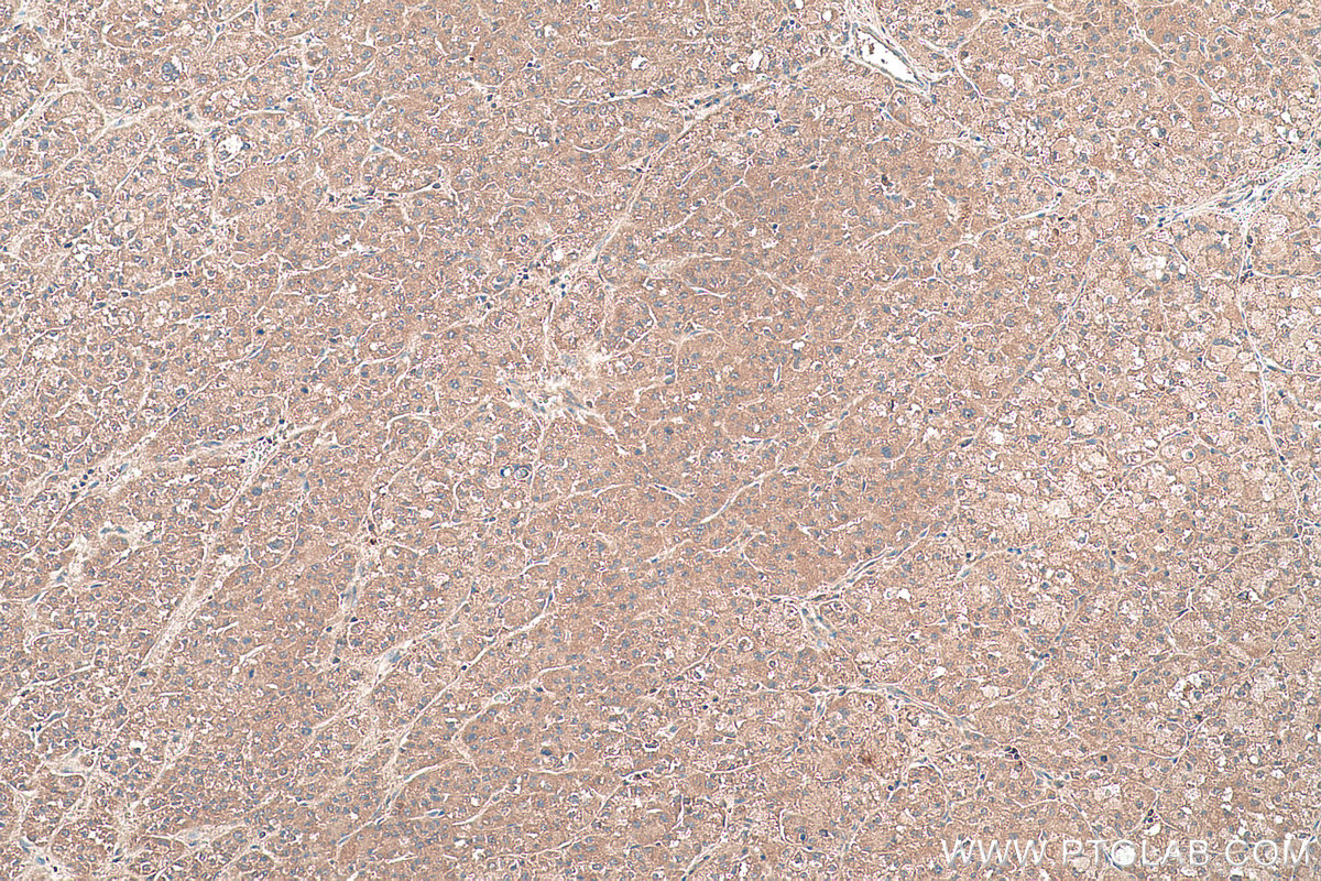 Immunohistochemical analysis of paraffin-embedded human liver cancer tissue slide using KHC0412 (CPNE8 IHC Kit).