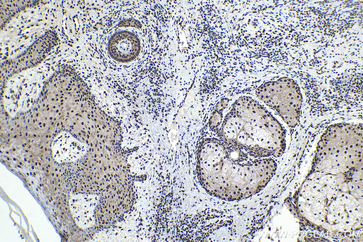 Immunohistochemical analysis of paraffin-embedded human skin cancer tissue slide using KHC1974 (CPSF2 IHC Kit).