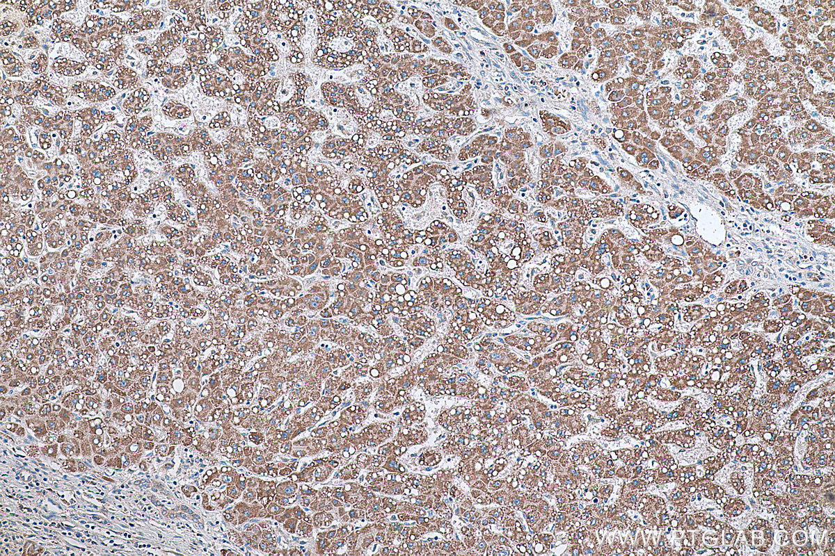 Immunohistochemical analysis of paraffin-embedded human liver cancer tissue slide using KHC0334 (CPT2 IHC Kit).