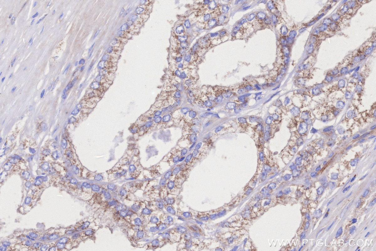 Immunohistochemical analysis of paraffin-embedded human prostate cancer tissue slide using KHC3263 (CPTP IHC Kit).