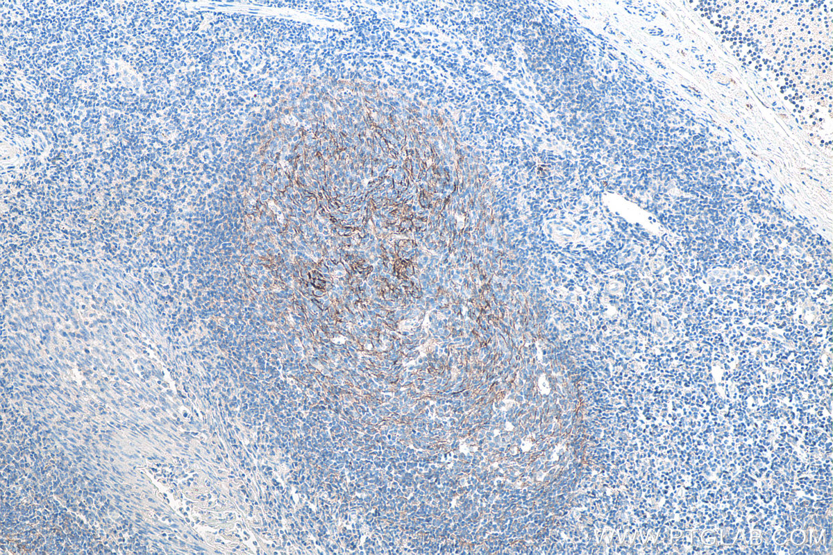 Immunohistochemical analysis of paraffin-embedded human tonsillitis tissue slide using KHC0102 (CR1/CD35 IHC Kit).