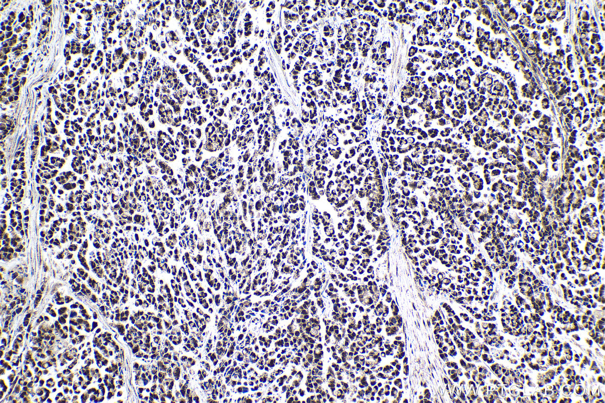 Immunohistochemical analysis of paraffin-embedded human colon cancer tissue slide using KHC1019 (CRCP IHC Kit).