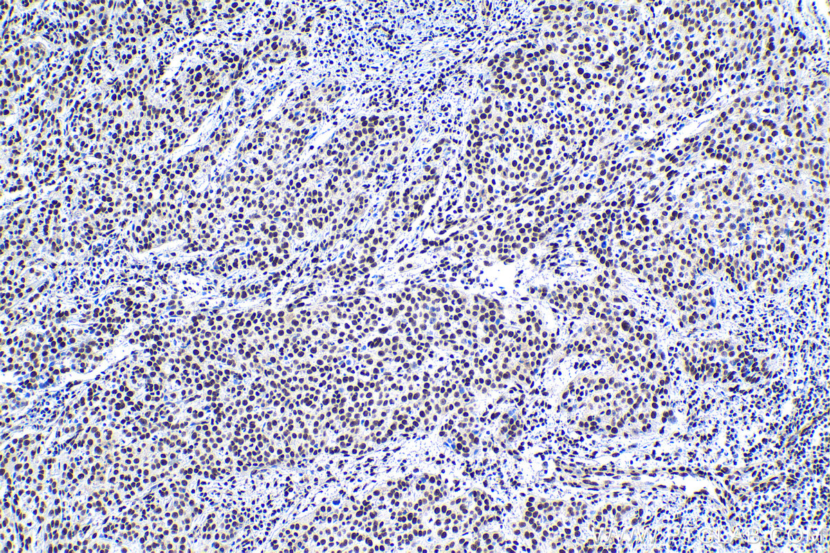 Immunohistochemical analysis of paraffin-embedded human cervical cancer tissue slide using KHC1124 (CREB1 IHC Kit).