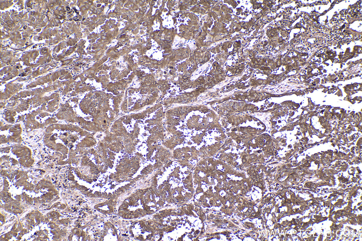 Immunohistochemical analysis of paraffin-embedded human lung cancer tissue slide using KHC1458 (CREB3 IHC Kit).