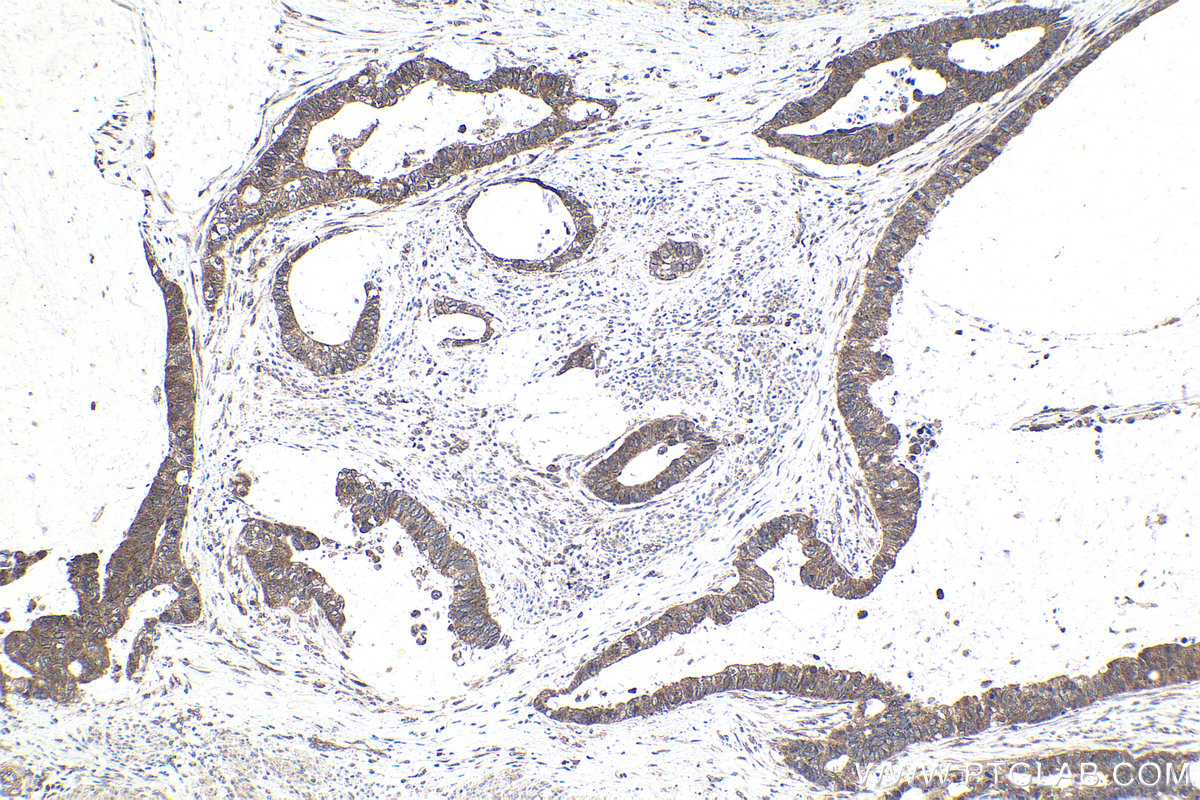 Immunohistochemical analysis of paraffin-embedded human urothelial carcinoma tissue slide using KHC1795 (CREB3L2 IHC Kit).