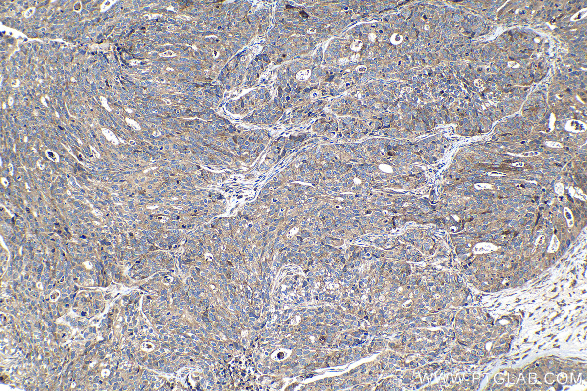 Immunohistochemical analysis of paraffin-embedded human ovary tumor tissue slide using KHC1111 (CRISP3 IHC Kit).