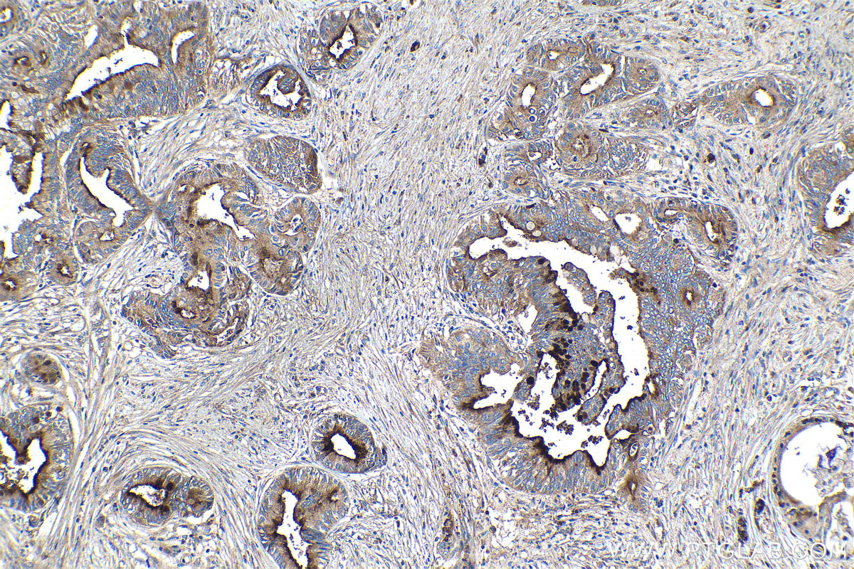 Immunohistochemical analysis of paraffin-embedded human pancreas cancer tissue slide using KHC1111 (CRISP3 IHC Kit).