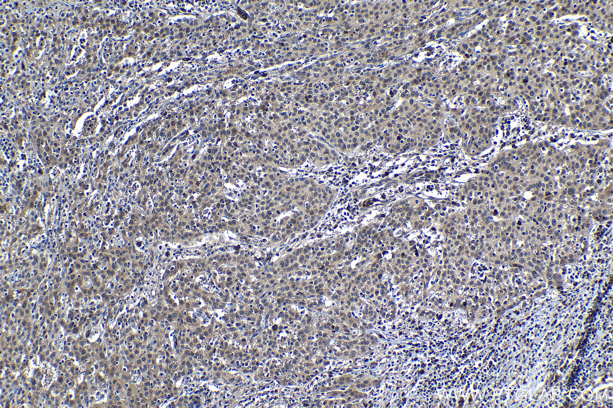 Immunohistochemical analysis of paraffin-embedded human cervical cancer tissue slide using KHC1213 (CRM1 IHC Kit).