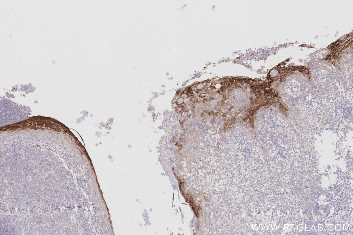 Immunohistochemical analysis of paraffin-embedded human tonsillitis tissue slide using KHC2999 (CRNN IHC Kit). Immunohistochemical analysis of paraffin-embedded human tonsillitis tissue slide using KHC2999 (CRNN IHC Kit).