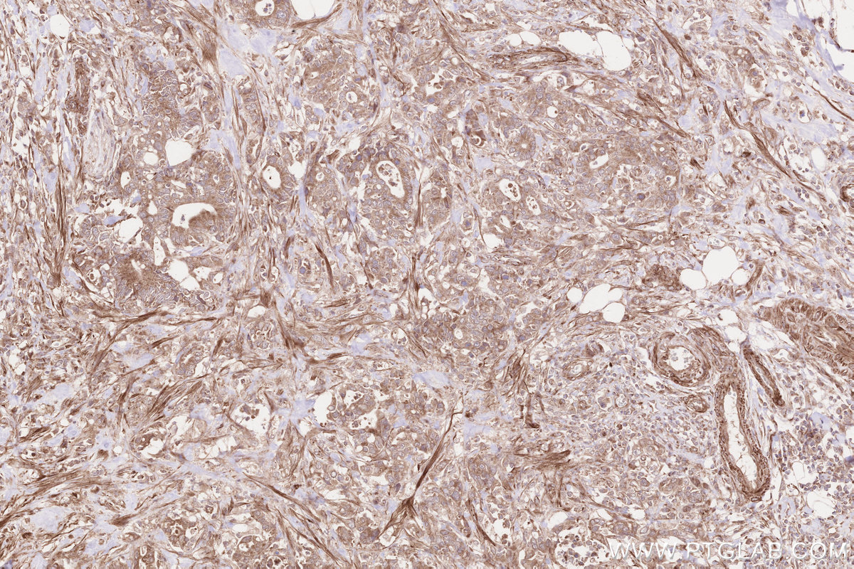 Immunohistochemical analysis of paraffin-embedded human rectal cancer tissue slide using KHC2559 (CROCC/Rootletin IHC Kit).
