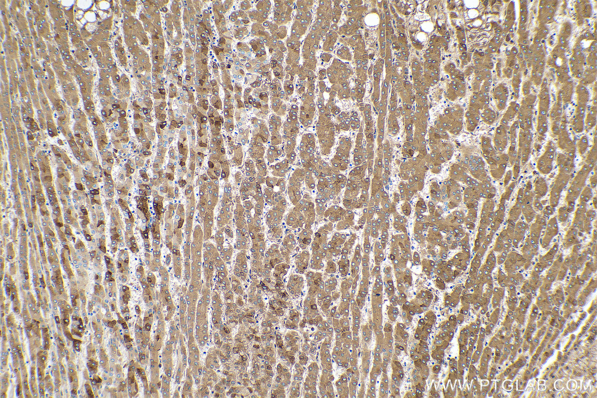 Immunohistochemical analysis of paraffin-embedded human liver cancer tissue slide using KHC0397 (CRP IHC Kit).