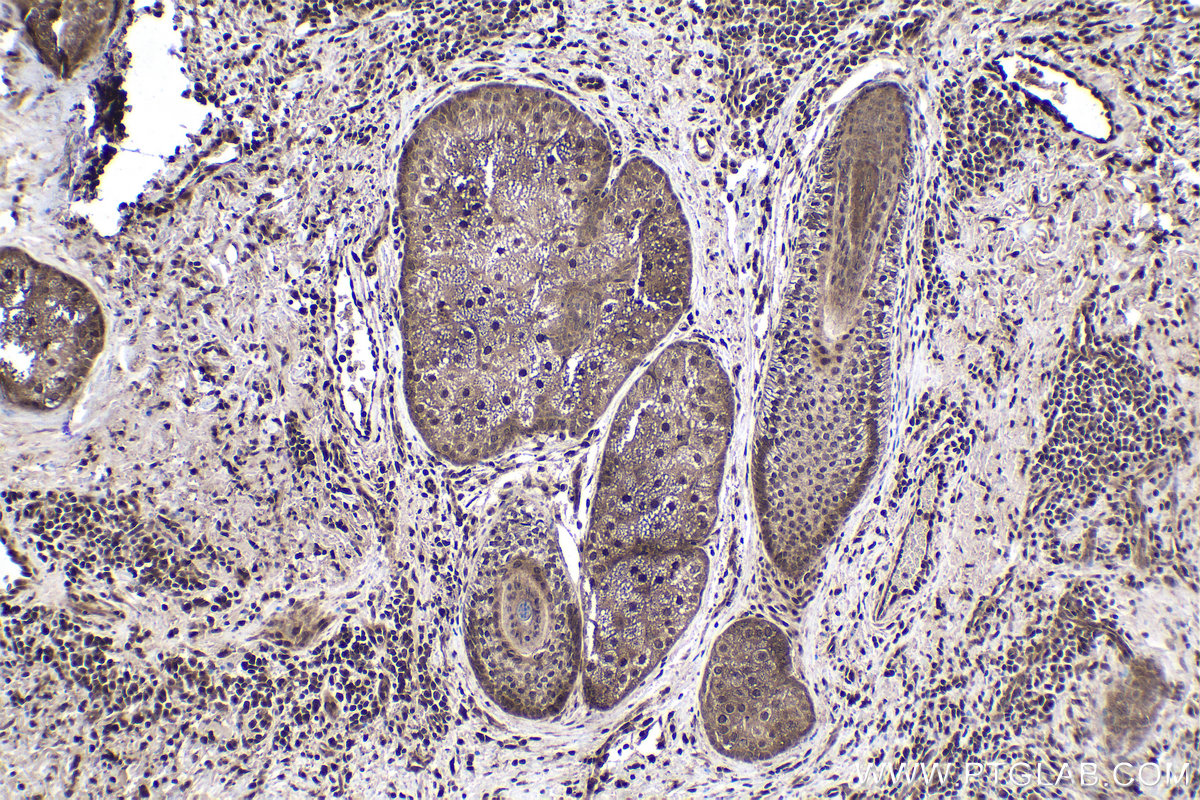 Immunohistochemical analysis of paraffin-embedded human skin cancer tissue slide using KHC1784 (CRTC2 IHC Kit).