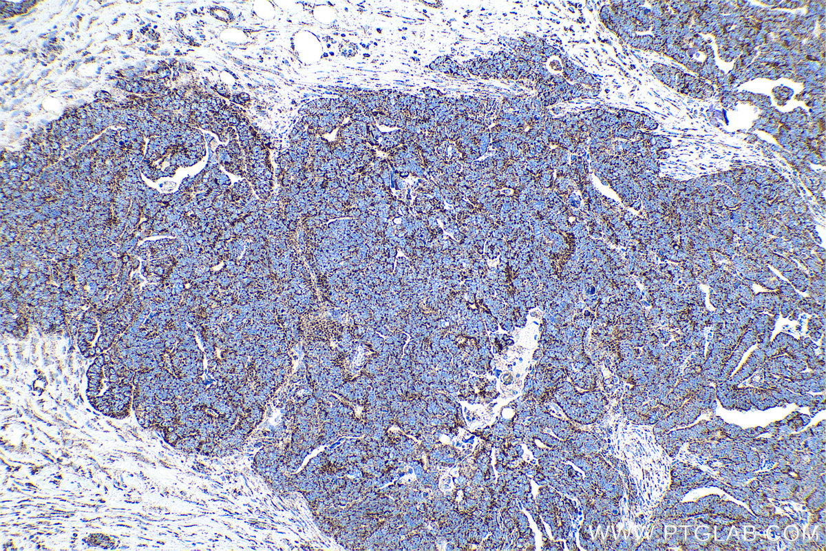 Immunohistochemical analysis of paraffin-embedded human ovary tumor tissue slide using KHC0877 (CS IHC Kit).