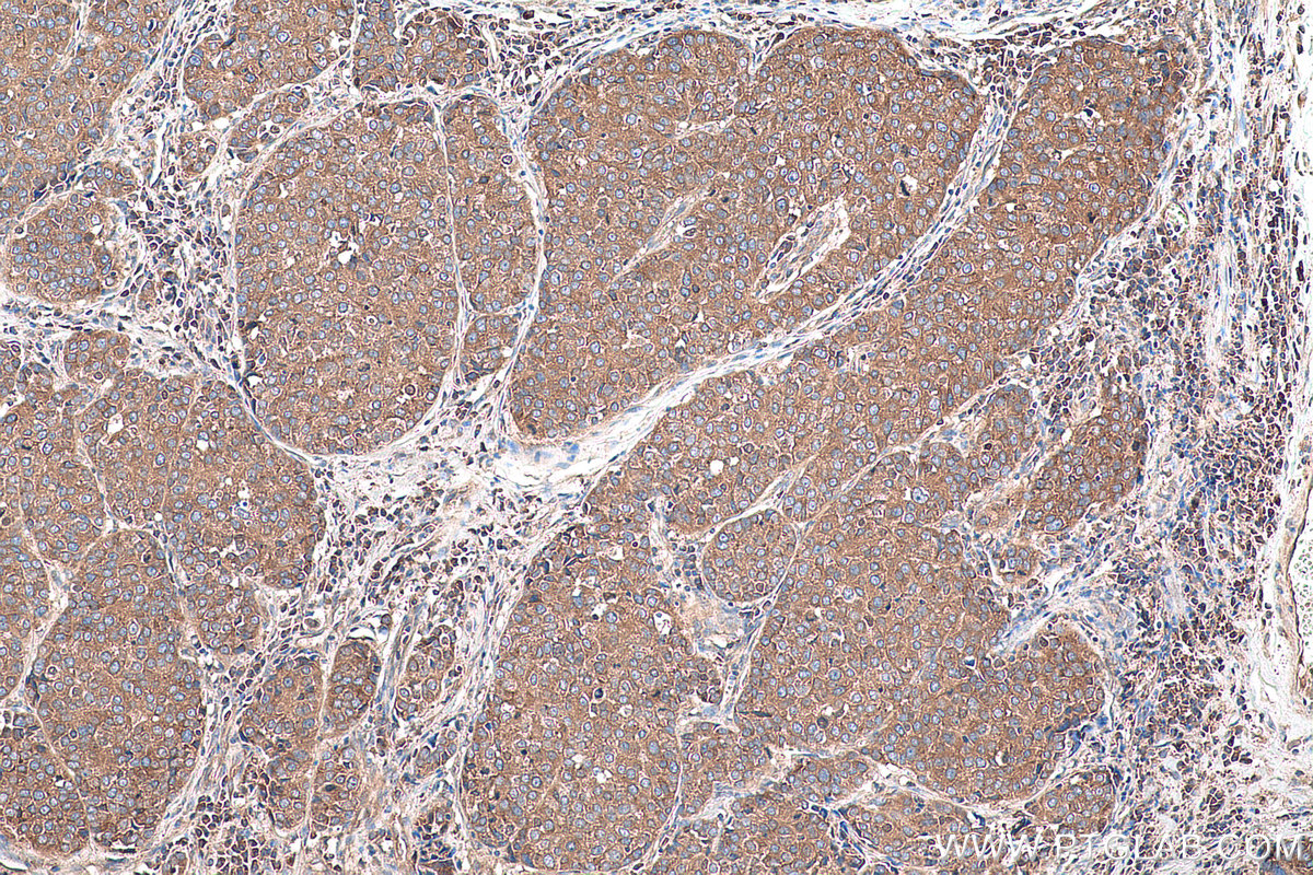 Immunohistochemical analysis of paraffin-embedded human stomach cancer tissue slide using KHC0902 (CSDE1 IHC Kit).