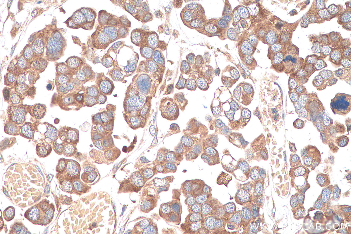 Immunohistochemical analysis of paraffin-embedded human colon cancer tissue slide using KHC0902 (CSDE1 IHC Kit).