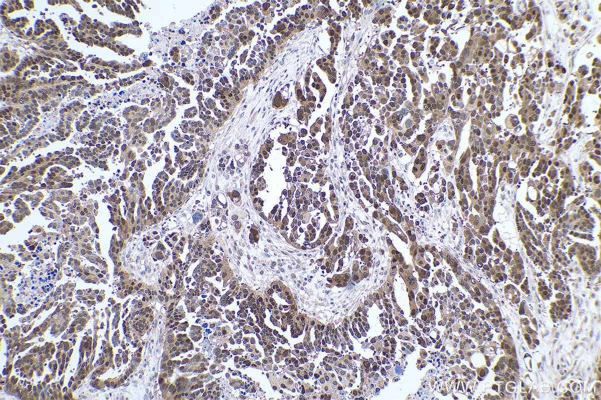 Immunohistochemical analysis of paraffin-embedded human colon cancer tissue slide using KHC0779 (CSE1L IHC Kit).