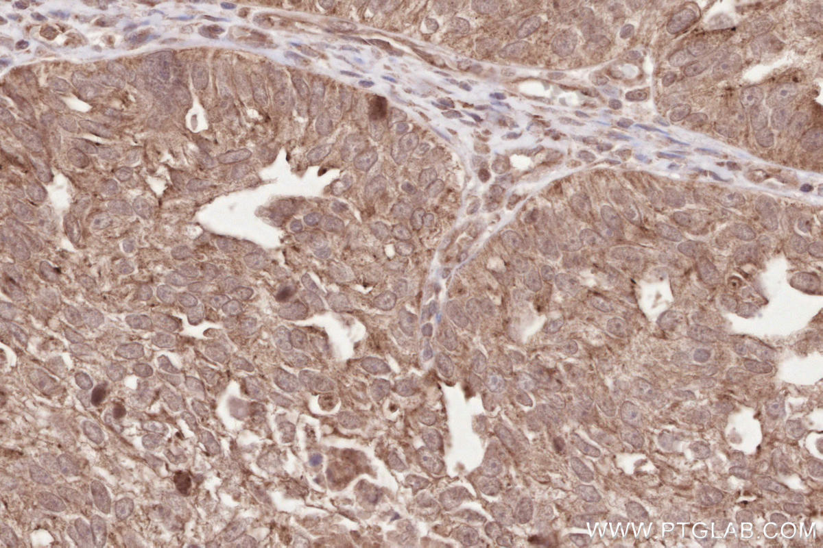 Immunohistochemical analysis of paraffin-embedded human ovary cancer tissue slide using KHC2524 (CSPP1 IHC Kit).