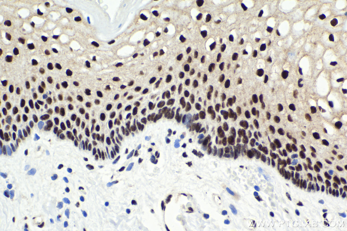 Immunohistochemical analysis of paraffin-embedded human cervical cancer tissue slide using KHC1580 (CSTF2 IHC Kit).