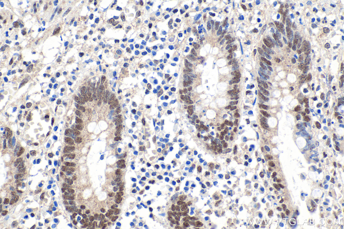 Immunohistochemical analysis of paraffin-embedded human appendicitis tissue slide using KHC1613 (CTCF IHC Kit).