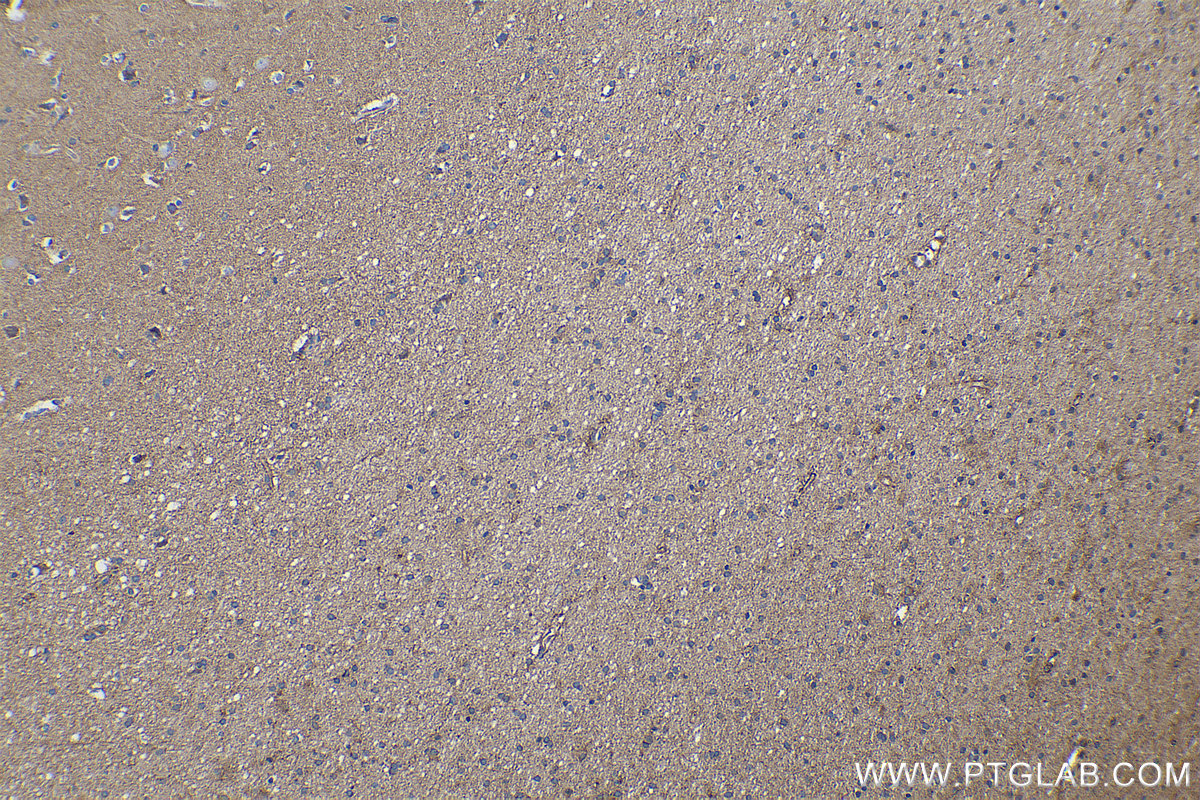 Immunohistochemical analysis of paraffin-embedded human gliomas tissue slide using KHC0261 (CTNNA2 IHC Kit).