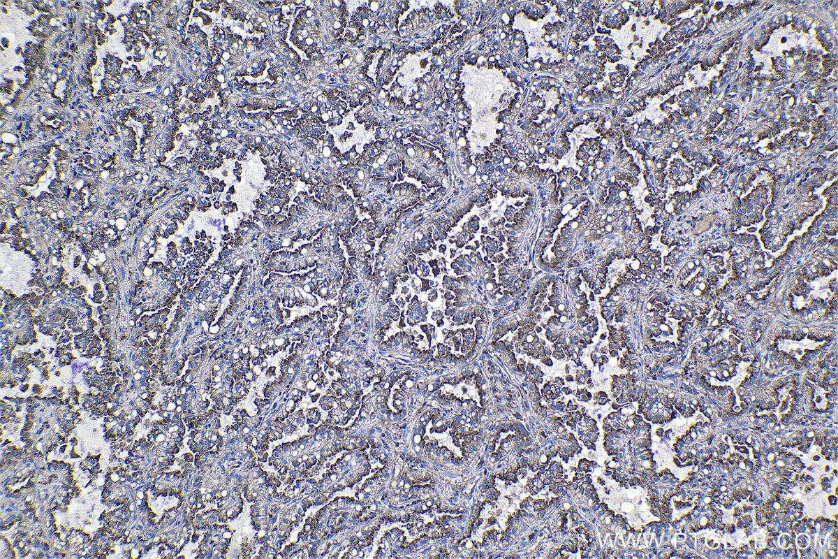 Immunohistochemical analysis of paraffin-embedded human lung cancer tissue slide using KHC1125 (CTSA IHC Kit).
