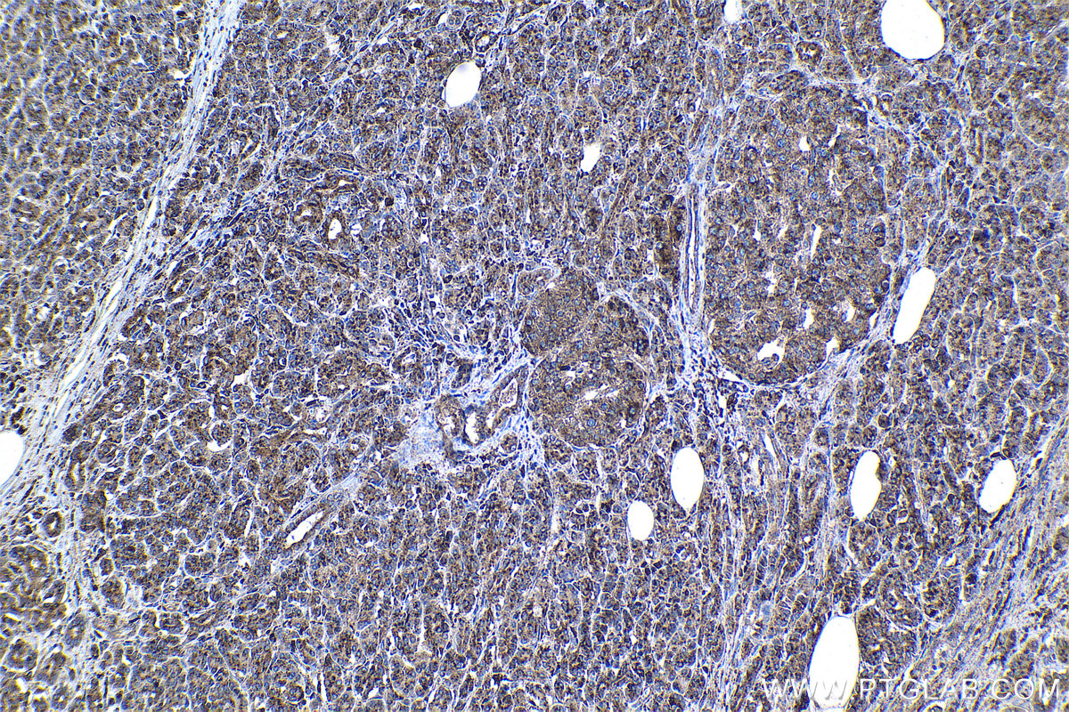 Immunohistochemical analysis of paraffin-embedded human pancreas cancer tissue slide using KHC1125 (CTSA IHC Kit).