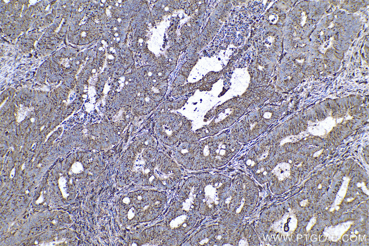 Immunohistochemical analysis of paraffin-embedded human colon cancer tissue slide using KHC0591 (Cathepsin D IHC Kit).