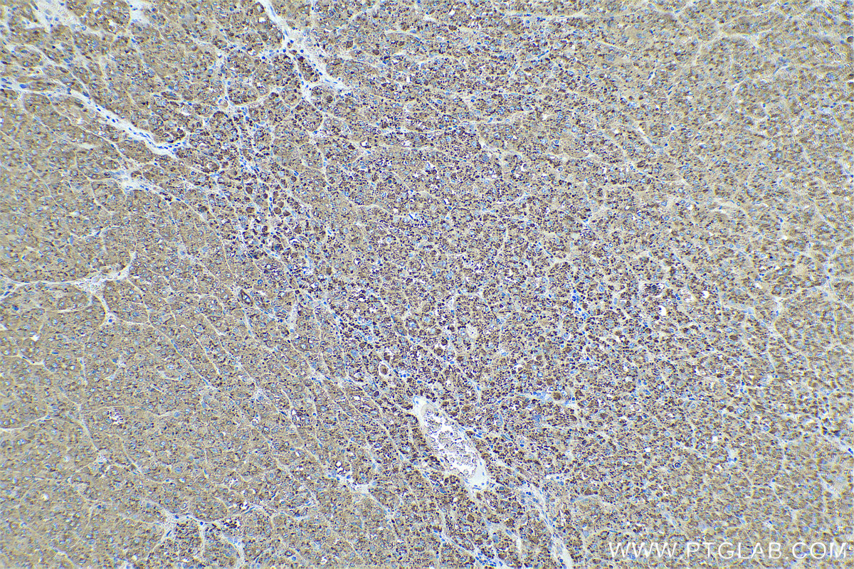 Immunohistochemical analysis of paraffin-embedded human liver cancer tissue slide using KHC0591 (Cathepsin D IHC Kit).