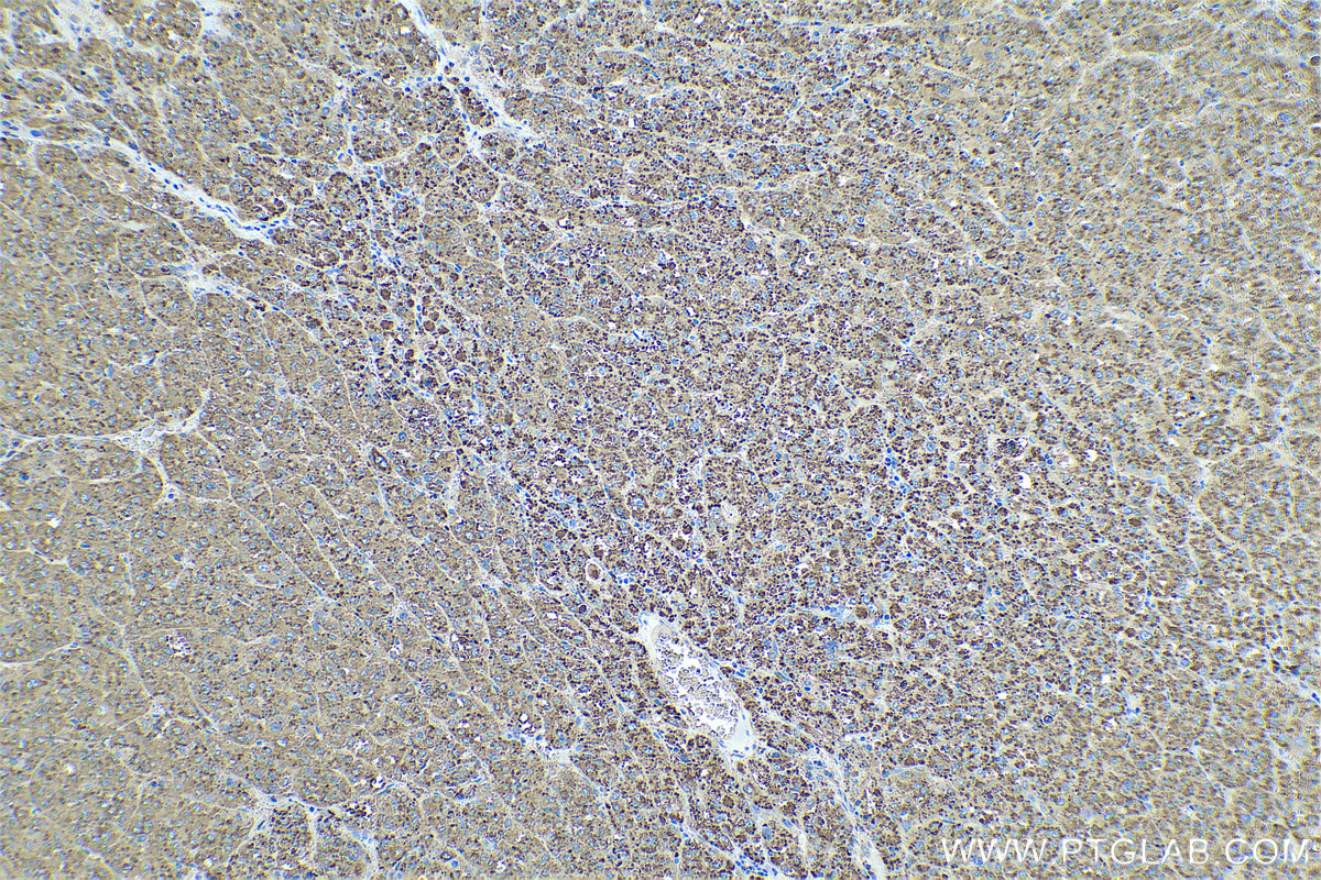 Immunohistochemical analysis of paraffin-embedded human liver cancer tissue slide using KHC0591 (Cathepsin D IHC Kit).
