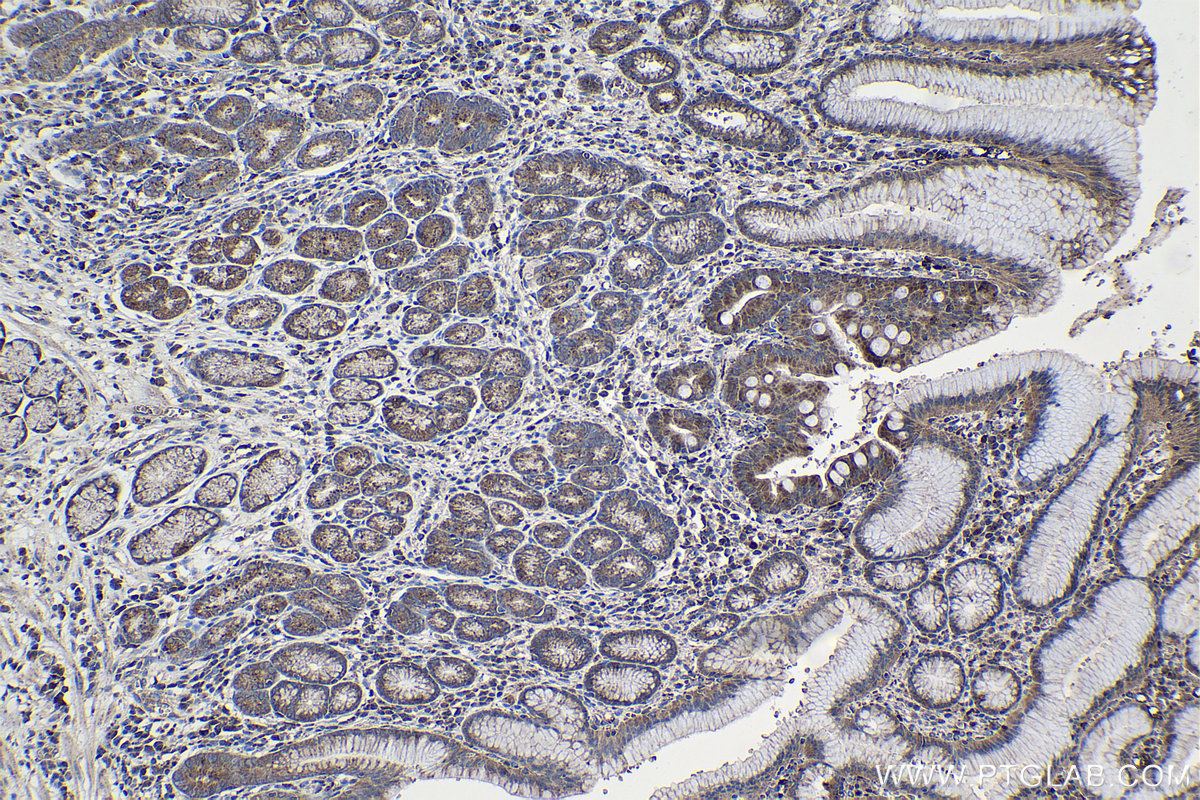 Immunohistochemical analysis of paraffin-embedded human stomach cancer tissue slide using KHC0990 (CTSZ IHC Kit).