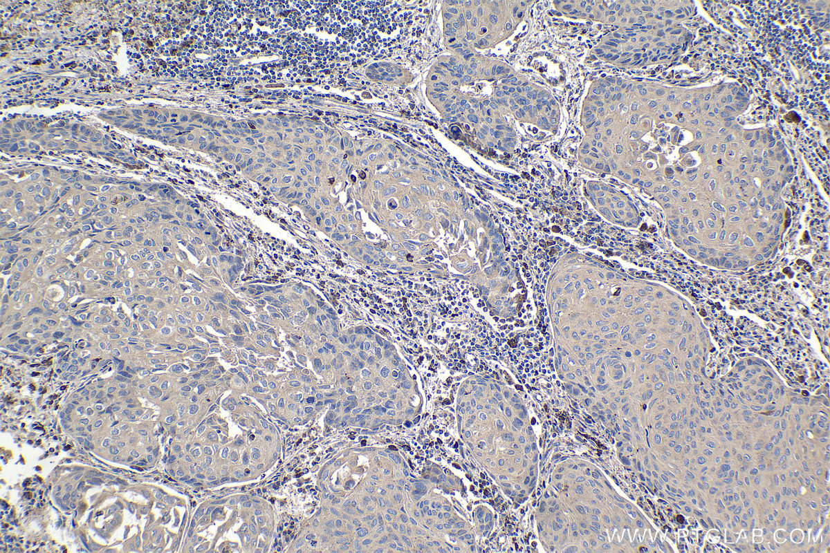 Immunohistochemical analysis of paraffin-embedded human lung cancer tissue slide using KHC0990 (CTSZ IHC Kit).