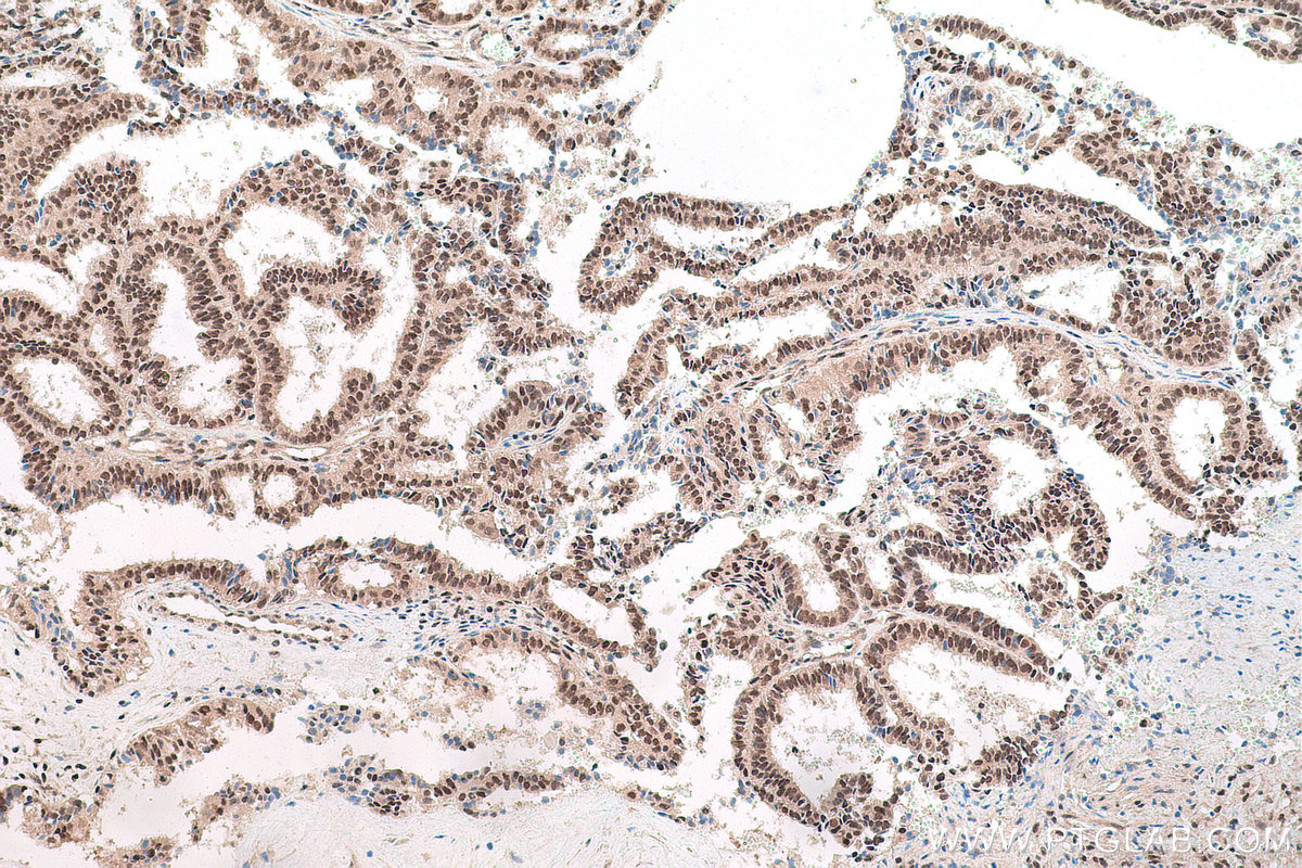 Immunohistochemical analysis of paraffin-embedded human ovary tumor tissue slide using KHC1718 (CUL4B IHC Kit).