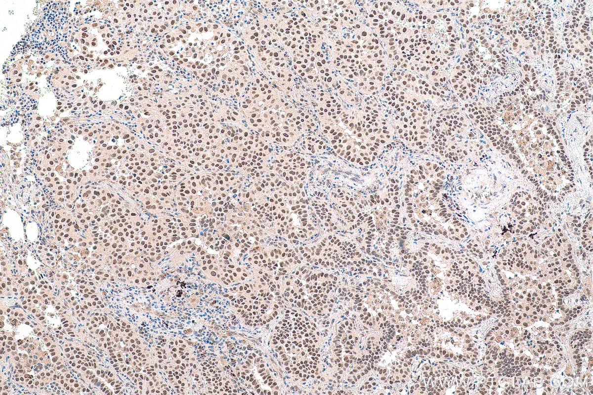 Immunohistochemical analysis of paraffin-embedded human lung cancer tissue slide using KHC1718 (CUL4B IHC Kit).