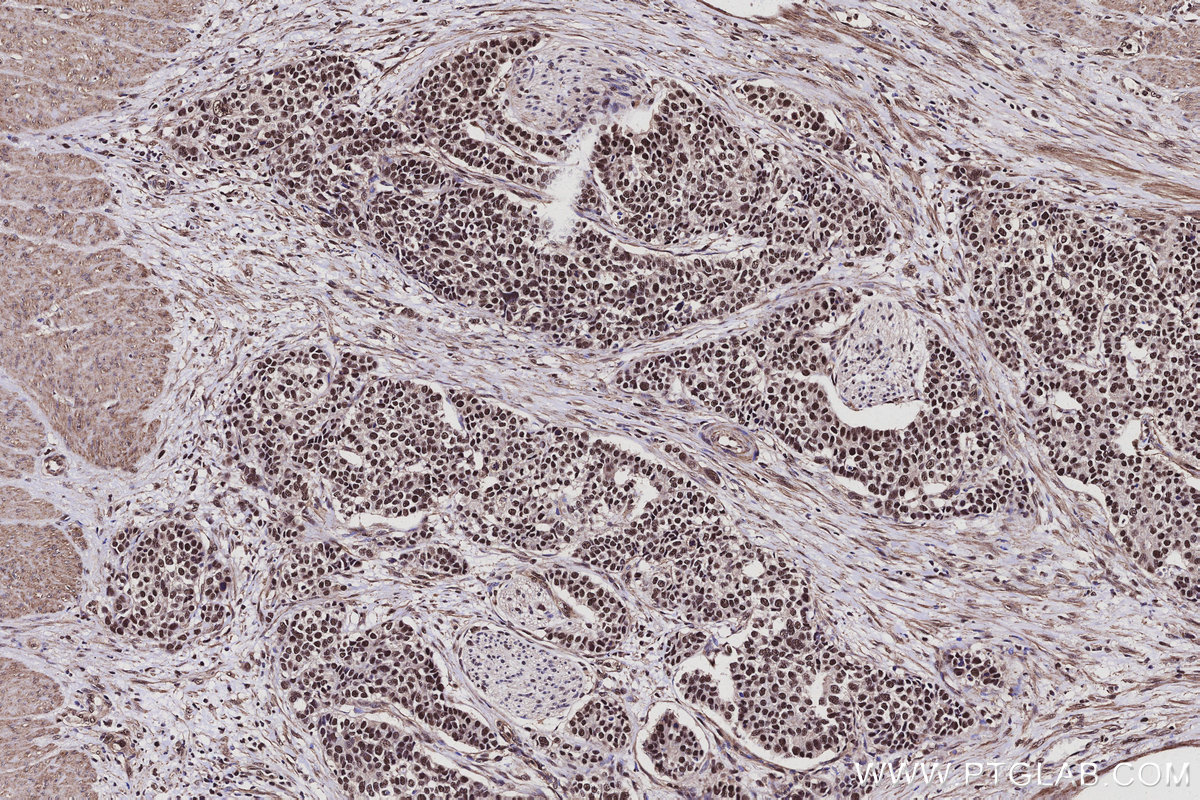 Immunohistochemical analysis of paraffin-embedded human stomach cancer tissue slide using KHC3103 (CWF19L1 IHC Kit).