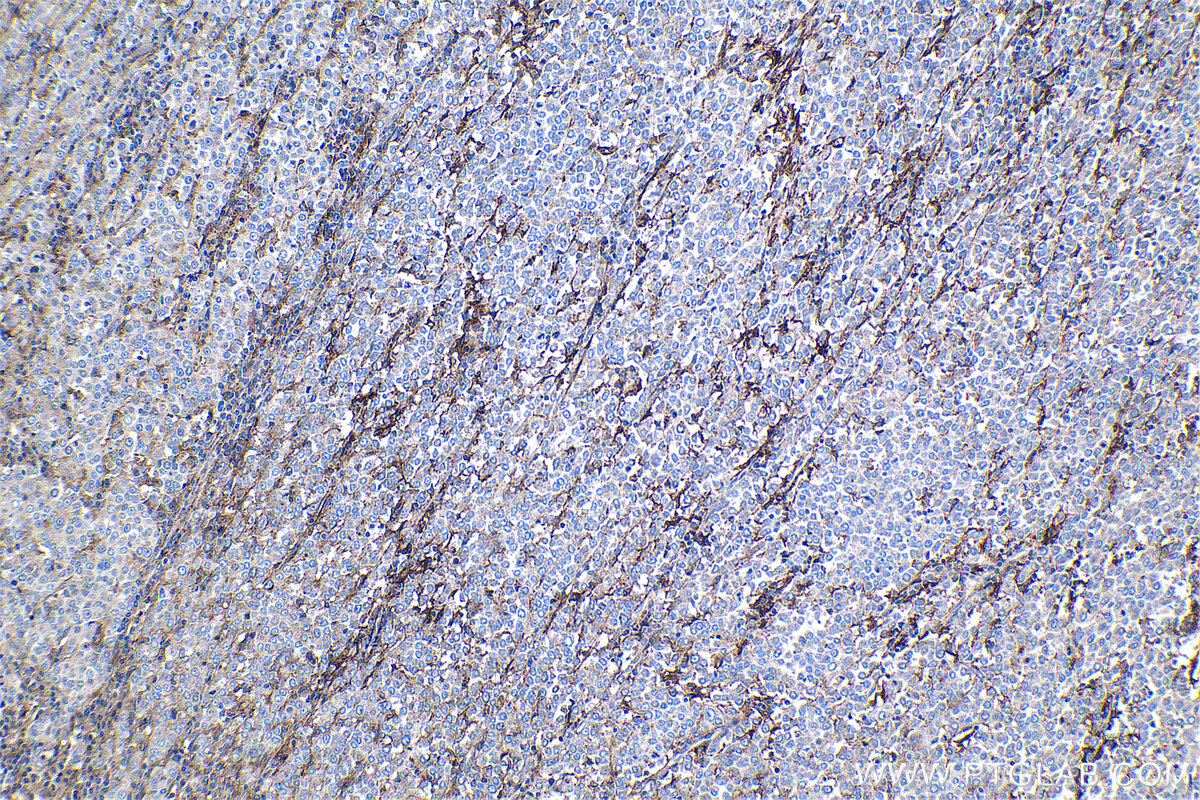 Immunohistochemical analysis of paraffin-embedded human ovary tumor tissue slide using KHC1297 (CXCL10/IP10 IHC Kit).