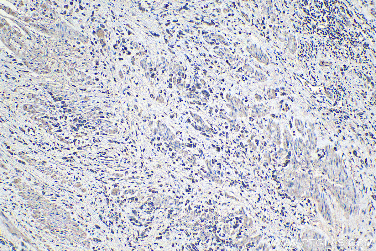 Immunohistochemical analysis of paraffin-embedded human stomach cancer tissue slide using KHC1246 (CXCL5 IHC Kit).
