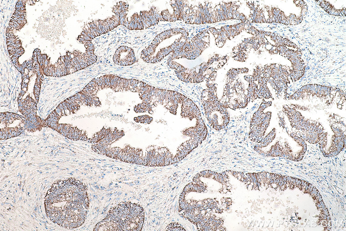 Immunohistochemical analysis of paraffin-embedded human pancreas cancer tissue slide using KHC0485 (CXCR4 IHC Kit).