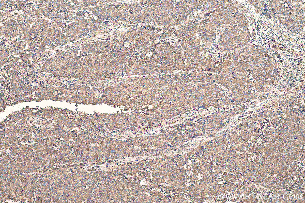 Immunohistochemical analysis of paraffin-embedded human stomach cancer tissue slide using KHC0699 (CYB5R3 IHC Kit).