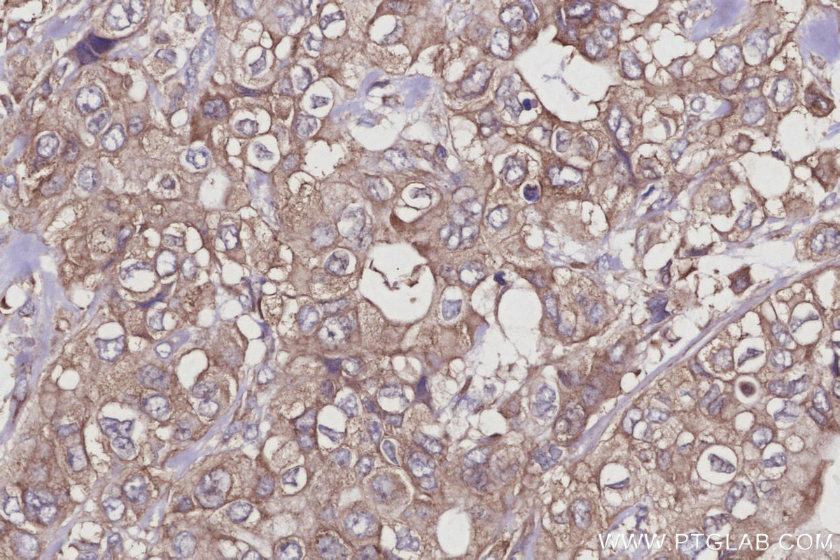 Immunohistochemical analysis of paraffin-embedded human pancreas cancer tissue slide using KHC2940 (CYLD IHC Kit).