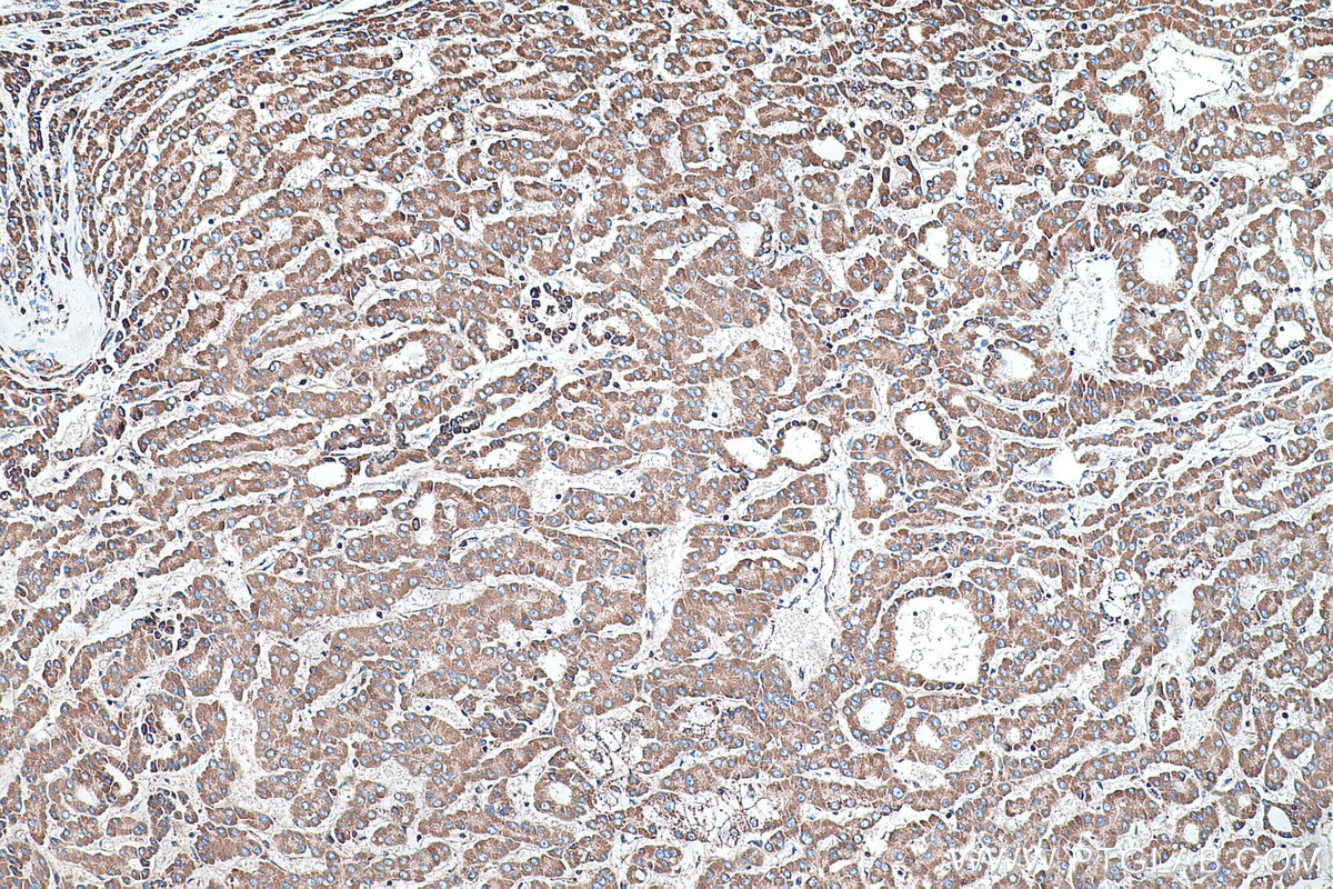 Immunohistochemical analysis of paraffin-embedded human liver cancer tissue slide using KHC0486 (CYP7B1 IHC Kit).
