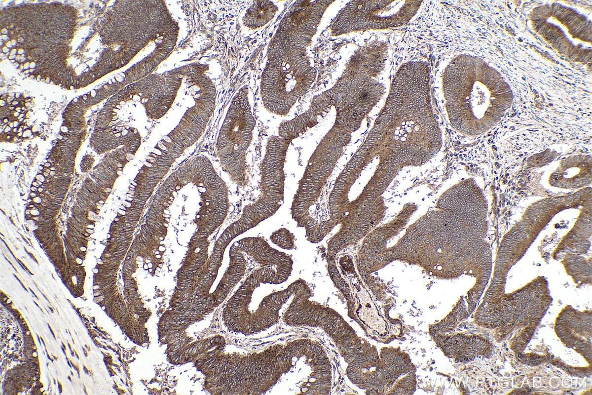 Immunohistochemical analysis of paraffin-embedded human colon cancer tissue slide using KHC0110 (CYR61 IHC Kit).