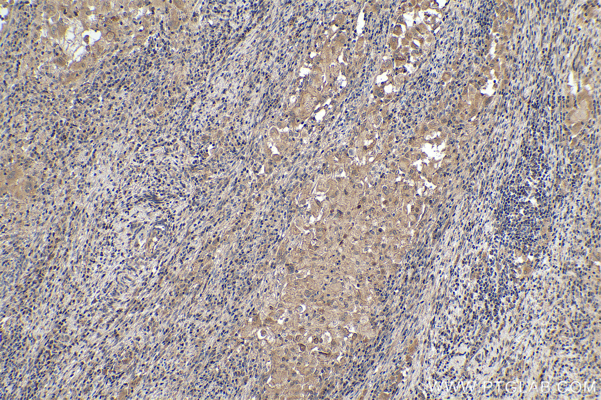 Immunohistochemical analysis of paraffin-embedded human cervical cancer tissue slide using KHC0373 (Cathepsin B IHC Kit).