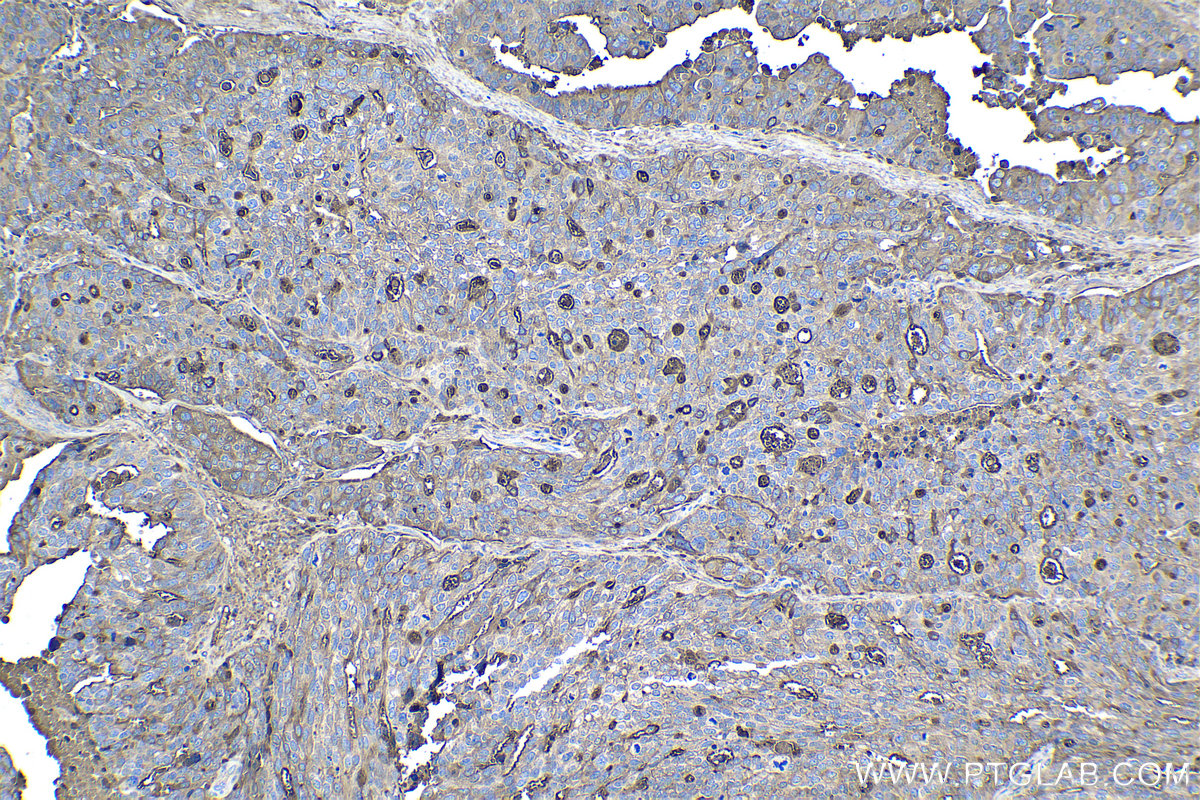 Immunohistochemical analysis of paraffin-embedded human ovary tumor tissue slide using KHC1122 (Ceruloplasmin/CP IHC Kit).