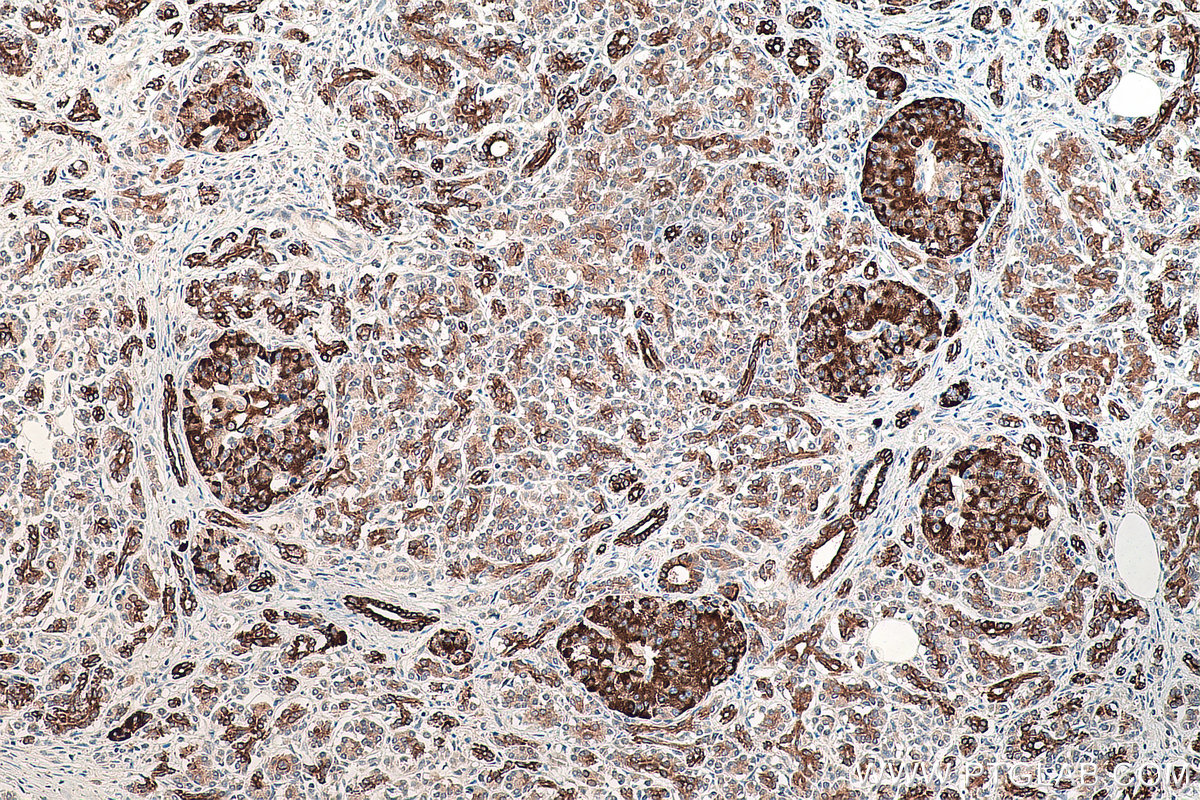 Immunohistochemical analysis of paraffin-embedded human pancreas cancer tissue slide using KHC0063 (Claudin 18 IHC Kit).
