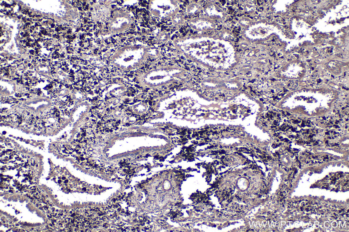 Immunohistochemical analysis of paraffin-embedded human lung cancer tissue slide using KHC1452 (DAPK3 IHC Kit).