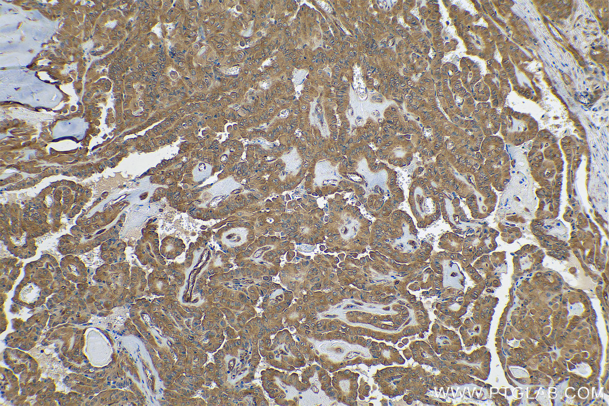 Immunohistochemical analysis of paraffin-embedded human thyroid cancer tissue slide using KHC0843 (DARS IHC Kit).