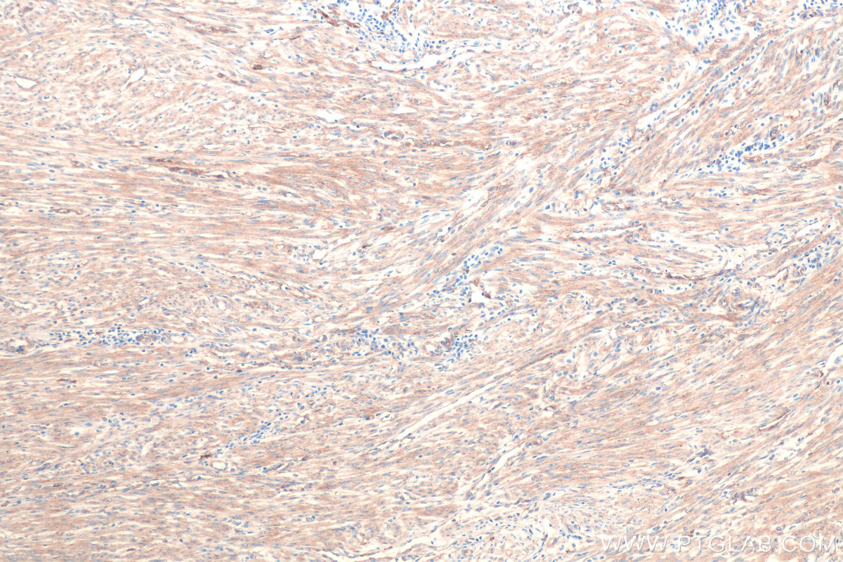 Immunohistochemical analysis of paraffin-embedded human endometrial cancer tissue slide using KHC0848 (DBN1/Drebrin IHC Kit).