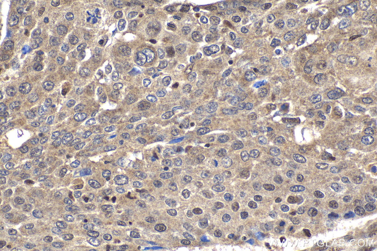 Immunohistochemical analysis of paraffin-embedded human lung cancer tissue slide using KHC2022 (DCAF1/VPRBP IHC Kit).