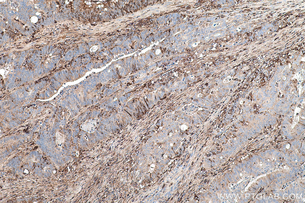 Immunohistochemical analysis of paraffin-embedded human colon cancer tissue slide using KHC0680 (DCN IHC Kit).