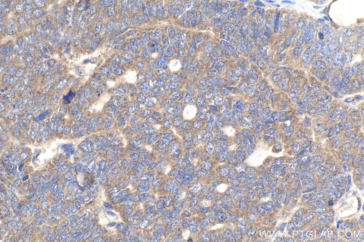 Immunohistochemical analysis of paraffin-embedded human ovary tumor tissue slide using KHC1956 (DCP1A IHC Kit).